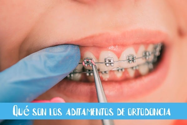 Qué son los aditamentos de ortodoncia